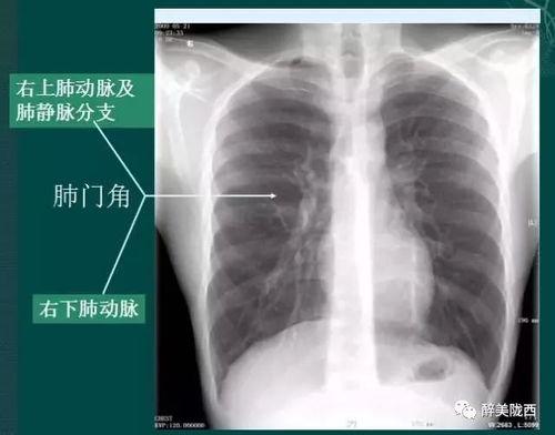 胸片爆料2023年最新版大揭秘,揭秘影像诊断新趋势