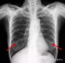 胸片爆料2023年最新版大揭秘,揭秘影像诊断新趋势